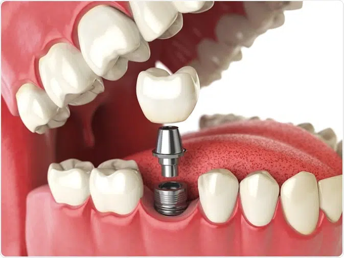 dental implants in forney tx