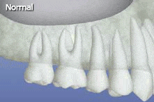vide illustration of how a sinus-lift works