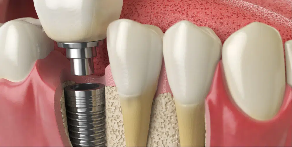 Illustration of dental implants for seniors in Forney, TX.