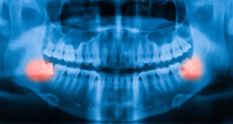 x-ray of Wisdom Teeth