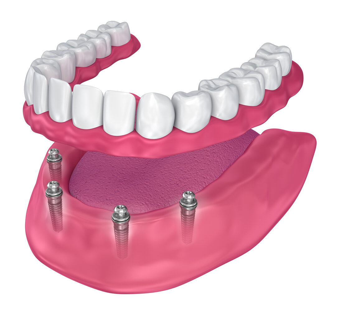 all on 4 dental implants