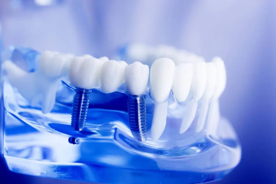 Dental Implants in Forney TX